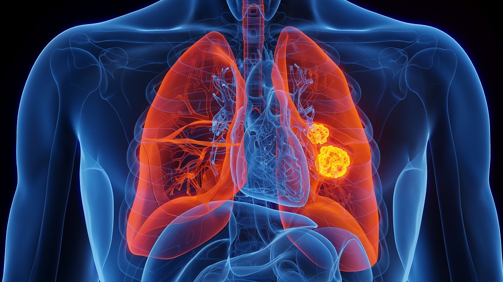 3D illustration representing lung cancer