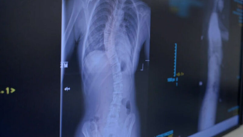 Image of scoliosis scan