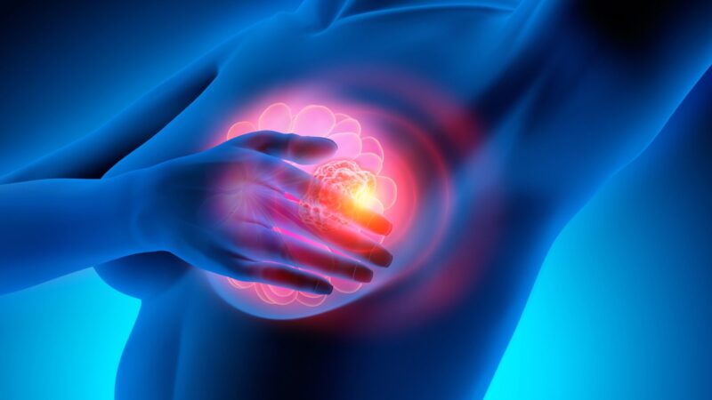 3D Digital image of breast cancer