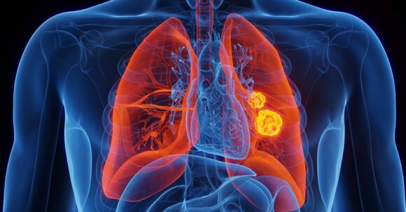 3D illustration representing lung cancer