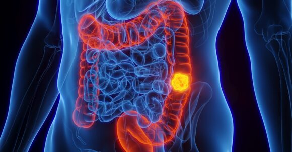 Bowel Colon Cancer