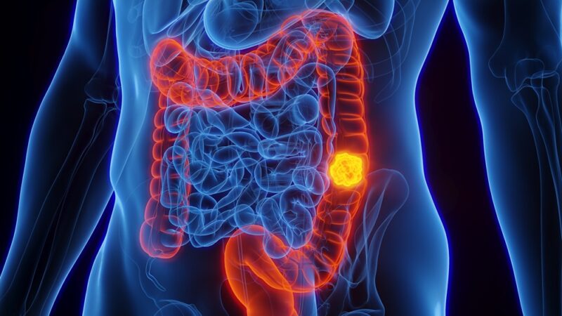 Bowel Colon Cancer