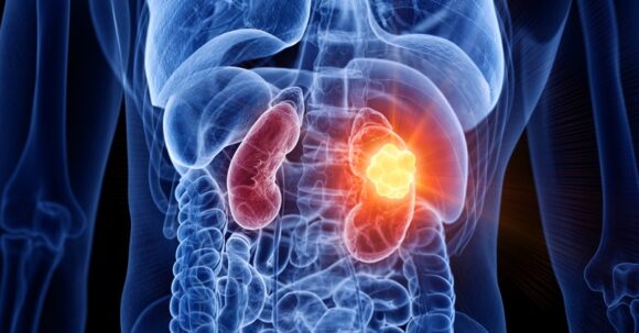 Kidney Cancer