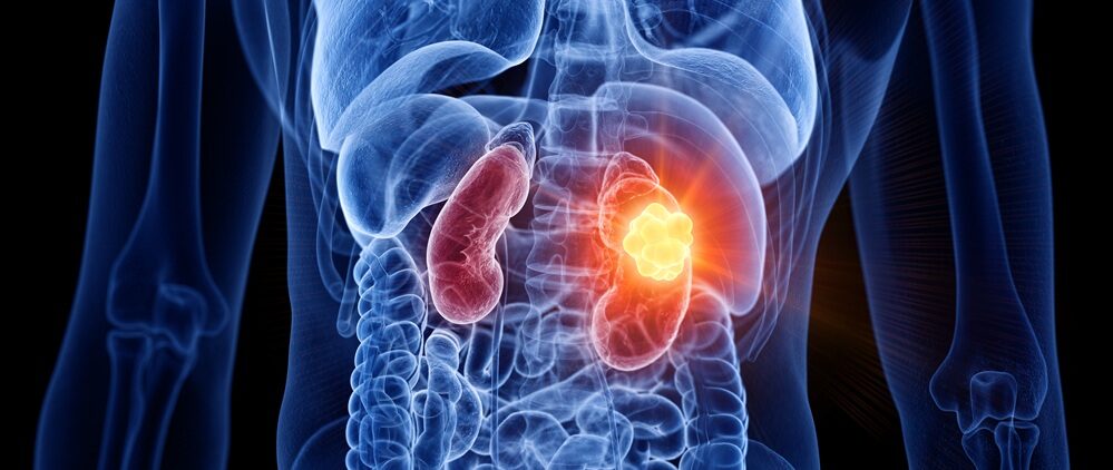 Kidney Cancer