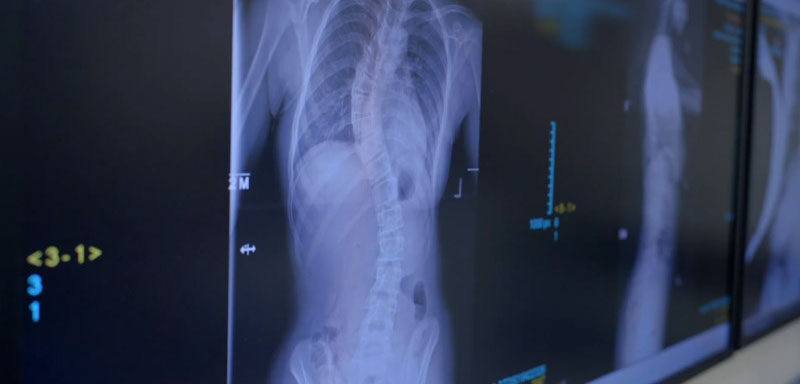 Image of scoliosis scan
